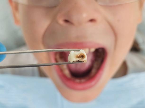 Best Emergency Root Canal Treatment in Burbank, WA